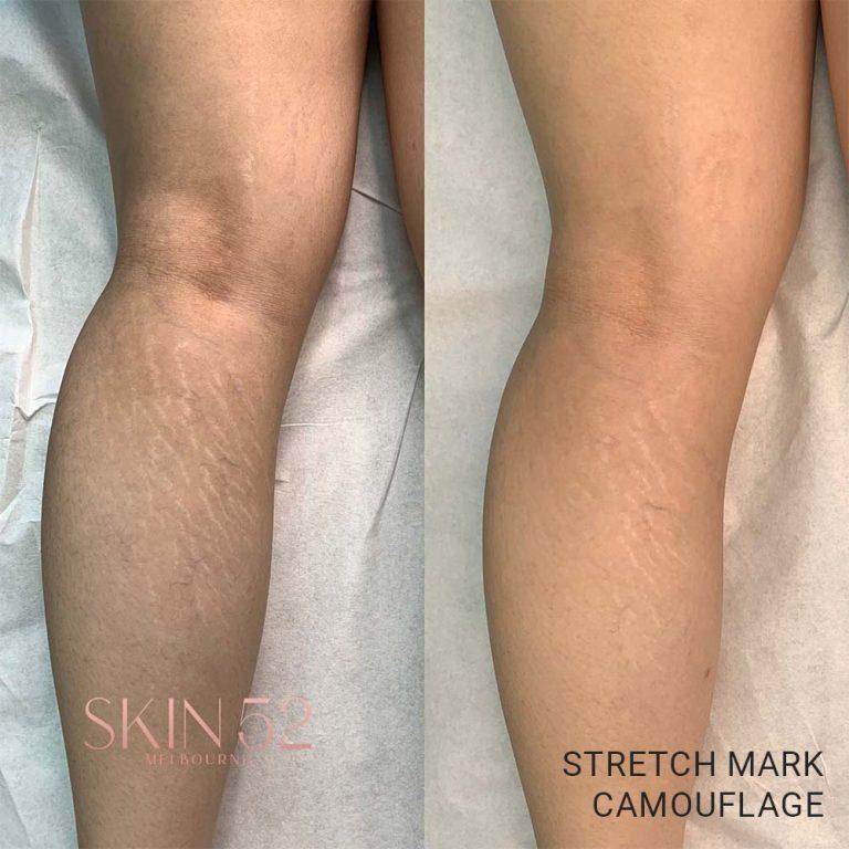 Stretch Mark Camouflage
